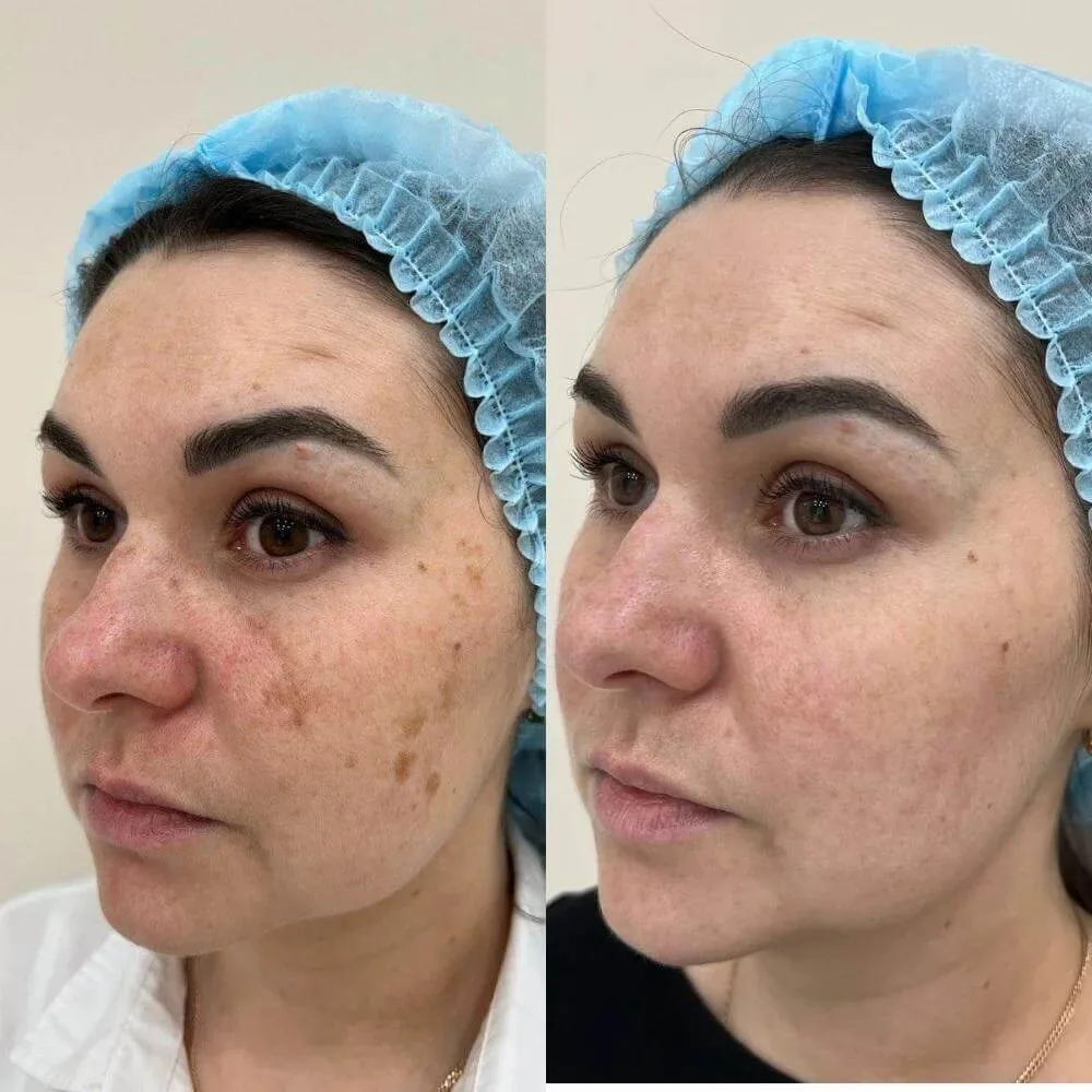 Before and after Pico pigmentation treatment, client photo 1