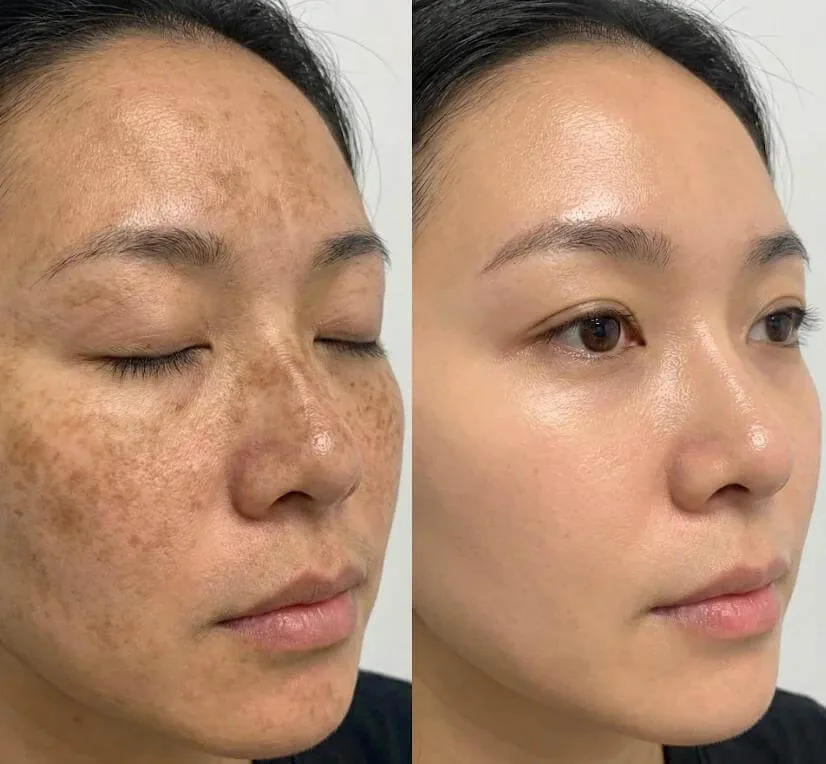 Before and after Pico pigmentation treatment, client photo 2