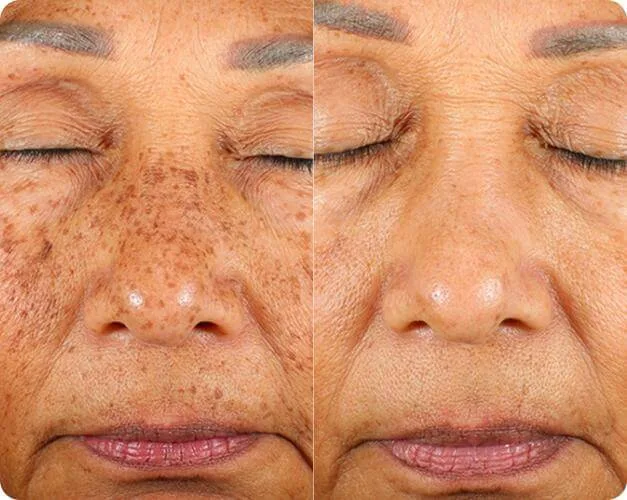 Before and after Pico pigmentation treatment, client photo 4