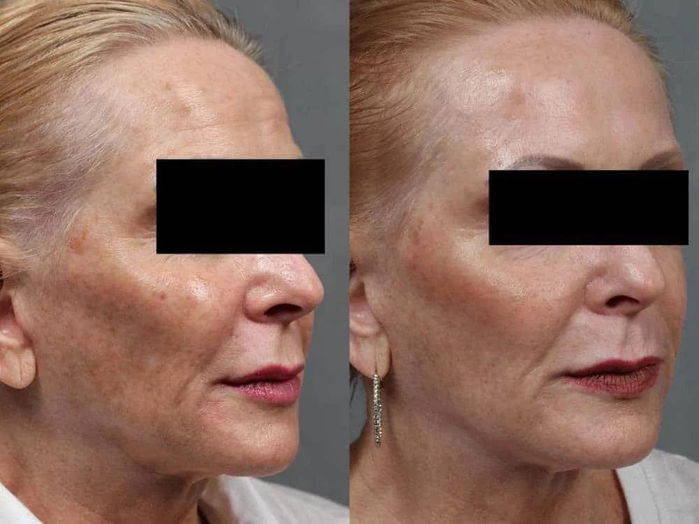 Before and after Pico pigmentation treatment, client photo 5